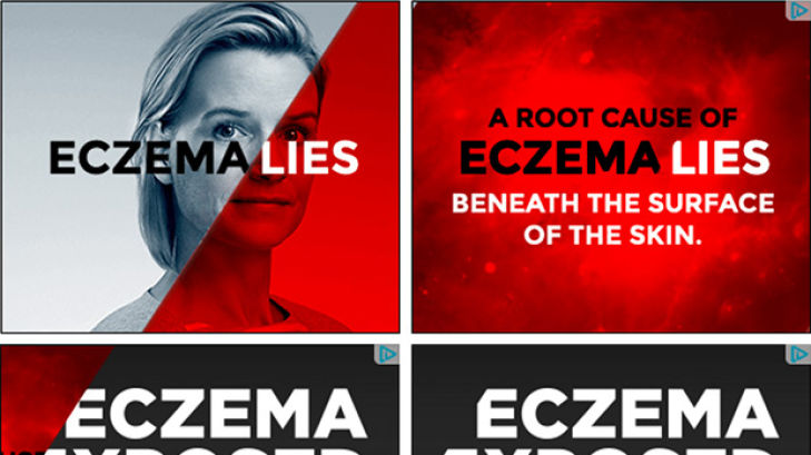 Eczema Exposed Patient Banner Ads
