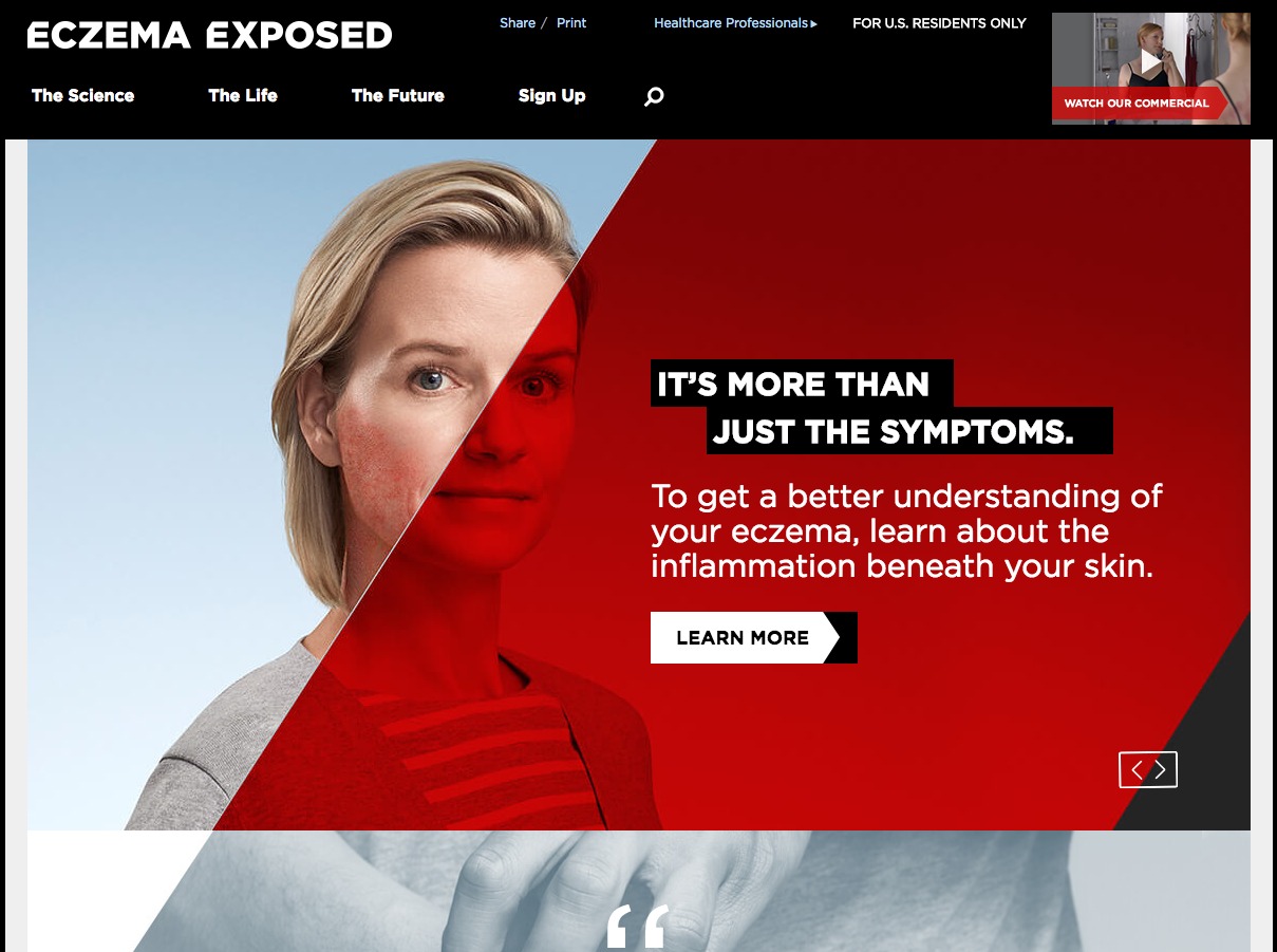 Market Development Website Eczema Exposed - Homepage Interactivity